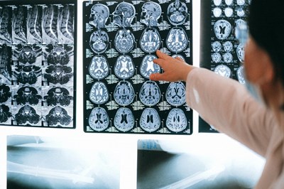 Multiple images of a brain scan to discuss brain health and foods bad for brain health.